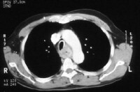 symptoms stomach cancer stages