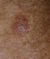 Psoriasis Minor