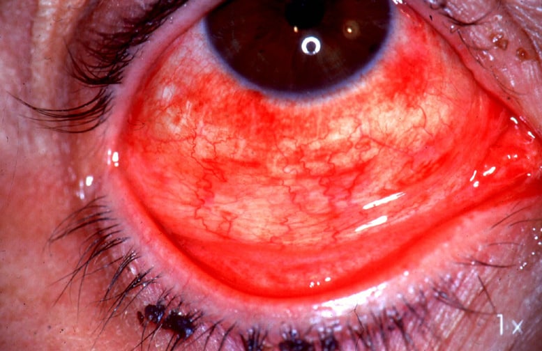 Follicular conjunctivitis and subconjunctival hemorrhage.