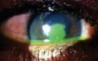 Corneal Tear