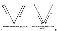 Pattern Exotropia