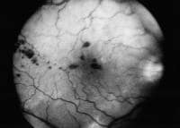 An impending bilateral central retinal vein obstru
