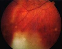 Lens Particle Glaucoma