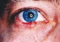 eyelid oil glands