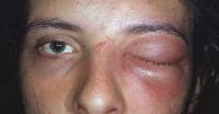 A male patient with orbital cellulitis with propto