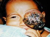 Retinoblastoma, extraocular stage (neglected with...
