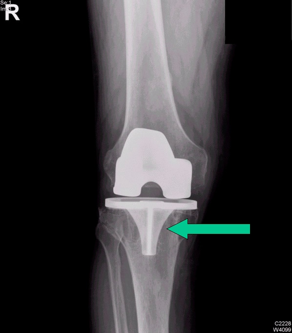 Osteolysis around a total knee implant.