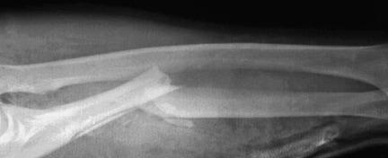 Grade IIIA open ulna fracture in a motorcyclist w...