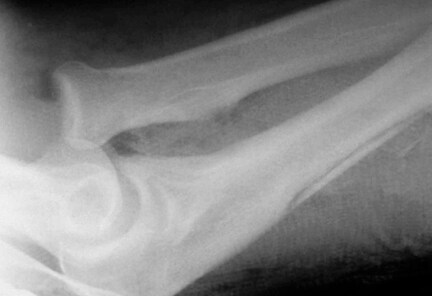 Close-up of radial head dislocation with evidence...