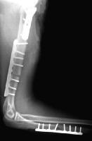 Definitive management of the fractures was perfor...