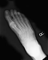 Preoperative radiograph shows degenerative joint d