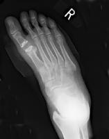 Postoperative radiograph obtained after resectiona