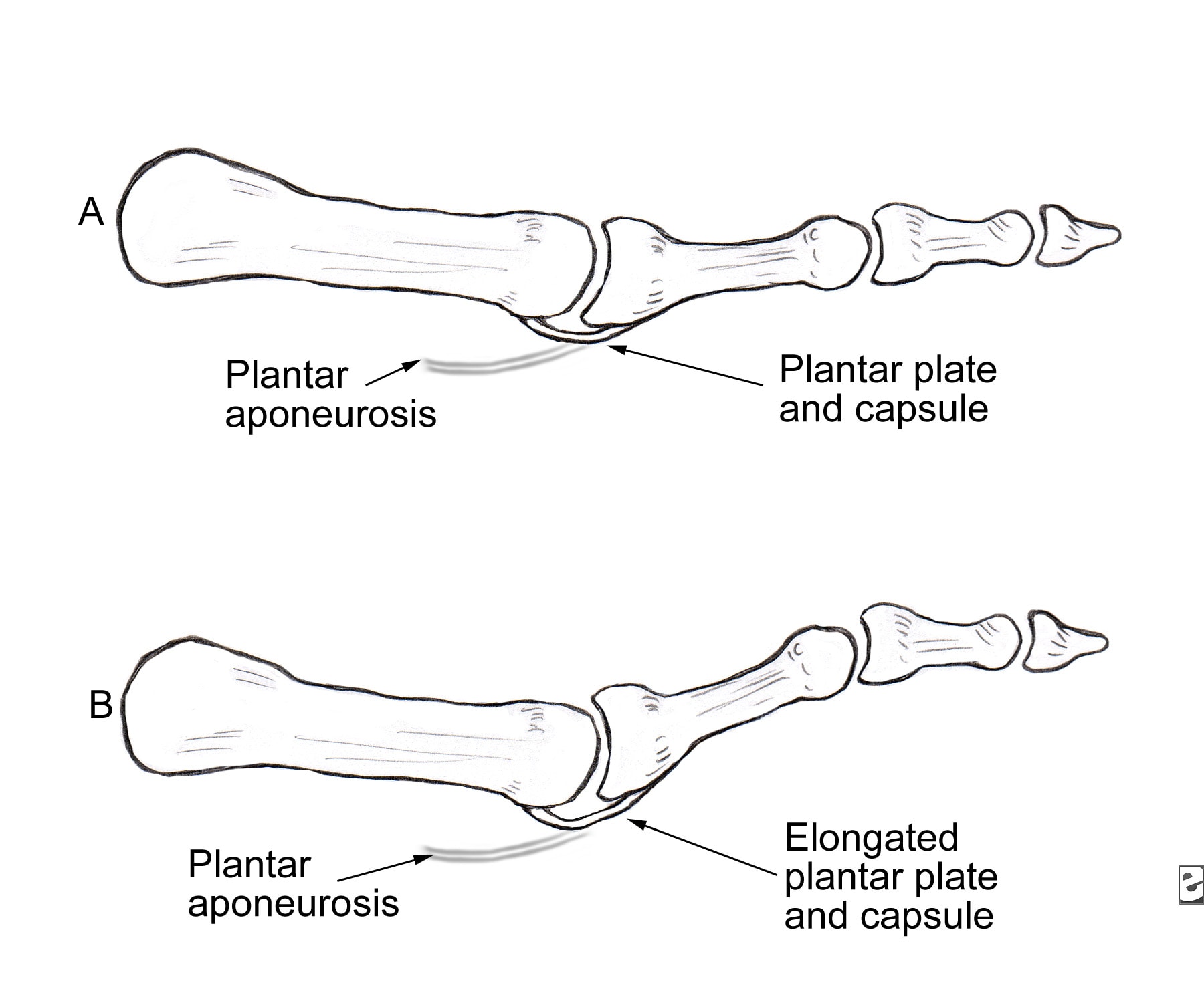 Hammertoe