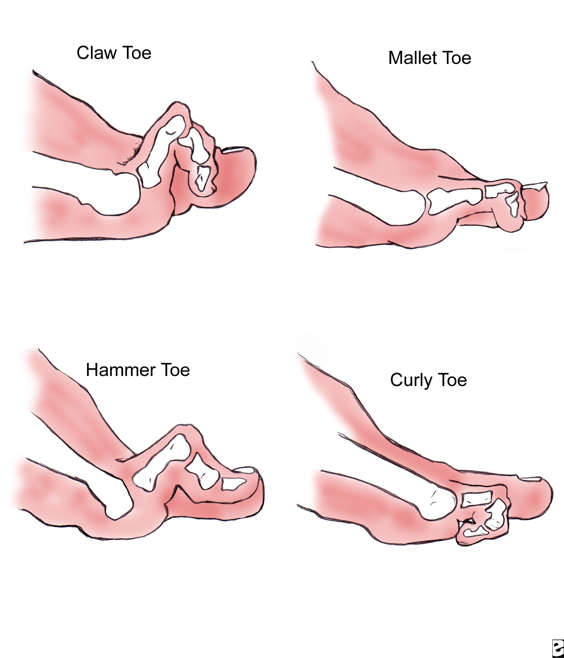 pinky toe hammer toe