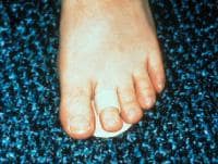 Plantar Fasciitis,Pes Planus,Mallet Toe,High Arched Feet,Heel Spur,Heel Pain,Hammer Toe,Hallux Valgus,Foot Pain,Foot Hard Skin,Foot Conditions,Foot Callous,Flat Feet,Fallen Arches,Diabetic Foot,Contracted Toe,Claw Toe,Bunions Hard Skin,Bunions Callous,Bunion Pain,Ball Of Foot Pain,Back Pain