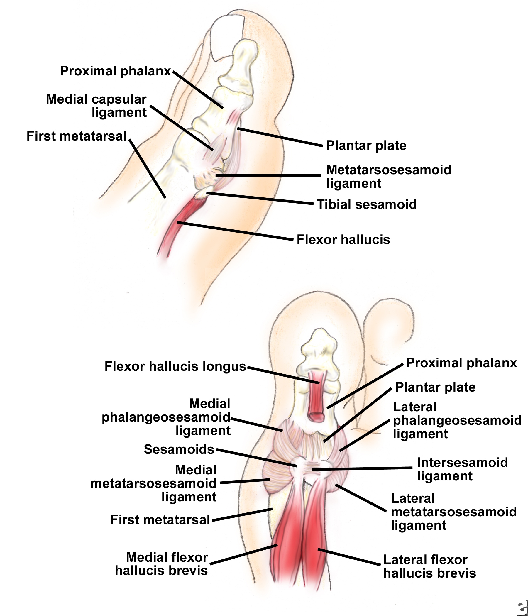 sesamoid surgery