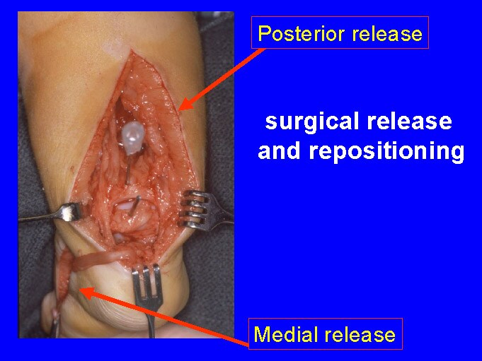 Posteromedial release for clubfoot.