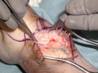 Ganglion Arm