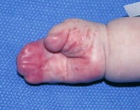 paronychia of finger