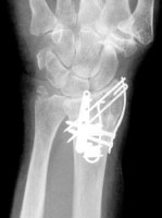 PA view of fragment-specific fixation (courtesy o...
