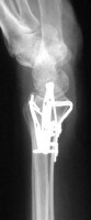 Lateral view of a fragment-specific fixation (cou...