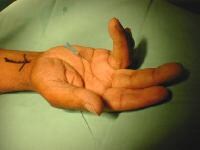 How to give steroid injection for trigger finger