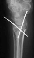 Percutaneous pinning with the Clancey technique, ...