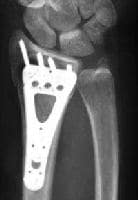 Volar fixed-angle plate using the Orthofix Contou...
