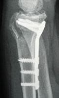 Volar fixed-angle plate using the Orthofix Contou...
