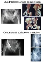 Quadrilateral Plate Pelvis