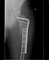 subtrochanteric fracture femur nail treatment hip revised reduction reverse fractures management obliquity stabilized blade short