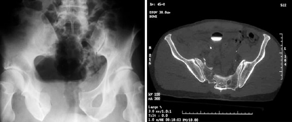 Lower Back Pain At 8 Weeks Pregnant