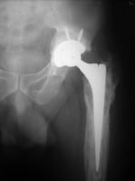 prothesis infection prothesis infection