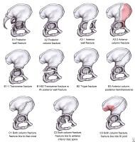 pelvic acetabular fracture