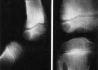 Garre Osteomyelitis