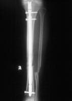 Standard anteroposterior radiograph of a tibial s...