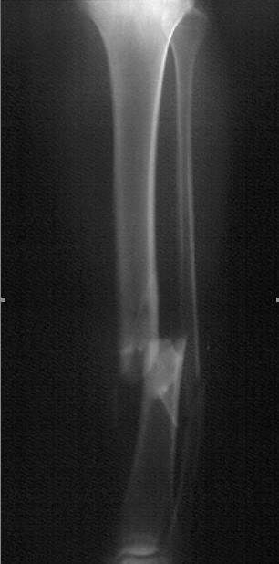 Radiograph demonstrating a displaced tibial shaft...