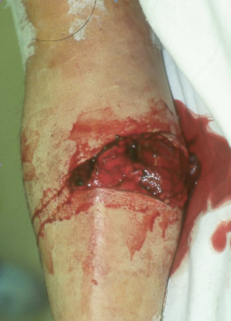 Open tibial shaft fracture.