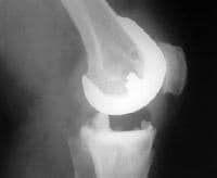 Complications of total knee arthroplasty. Postoper