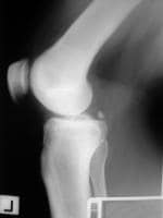 acl avulsion fracture