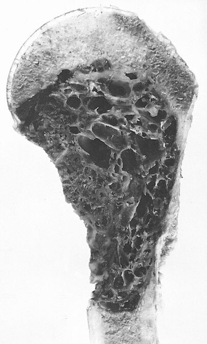 aneurysmal bone cyst rib. Aneurysmal bone cyst of the