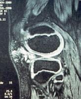 Synovial Haemangioma