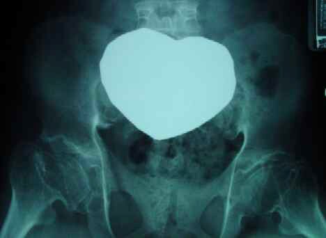 Pelvis with both hips in an adult with diastrophic dysplasia.