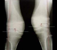 Normal Knee Alignment