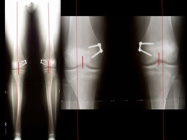 Example Of Nursing Care Plan For Fracture