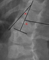 Rib Vertebral Angle