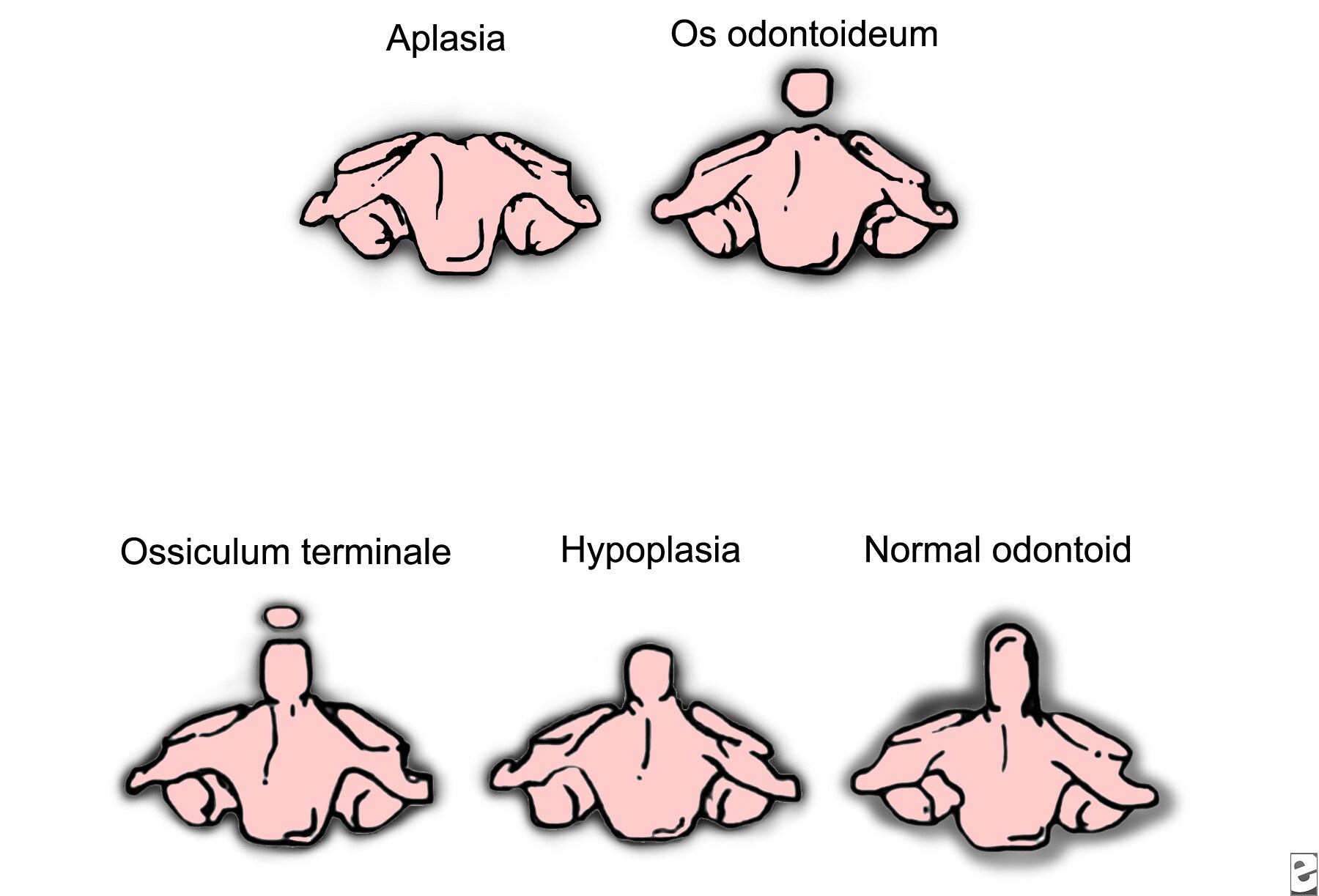 Odontoid Hypoplasia