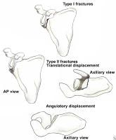 Classification of glenoid neck fractures. Type I ...