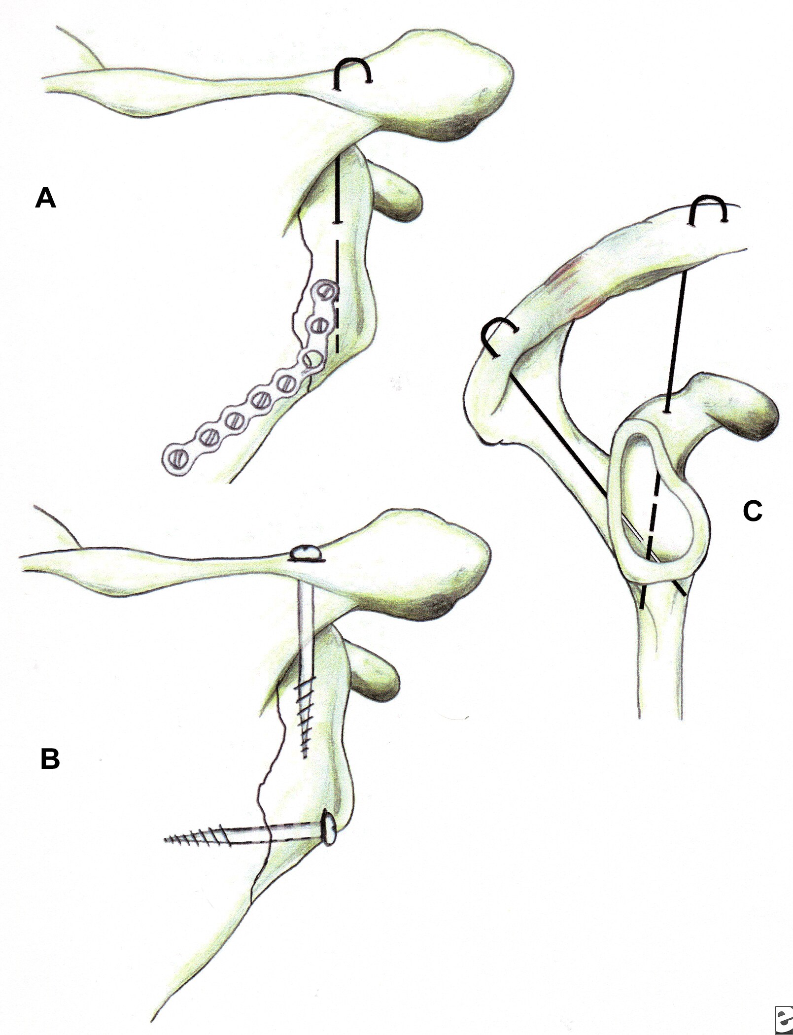 Coracoid Process Fracture