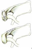 Fixation of acromion fractures. (A) tension band ...
